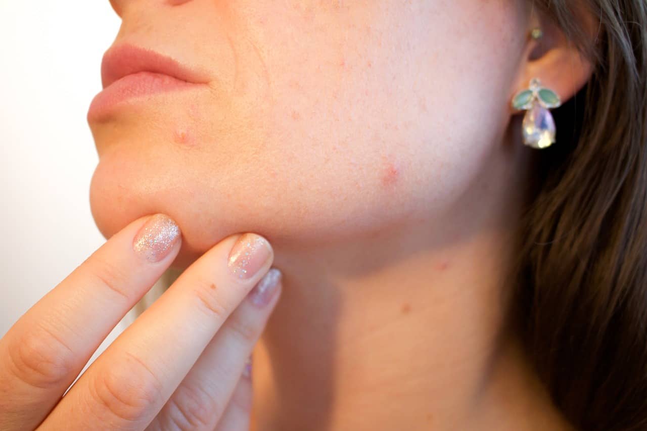 Treating Your Acne post thumbnail image