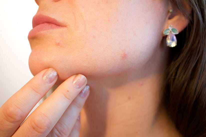 Treating Your Acne